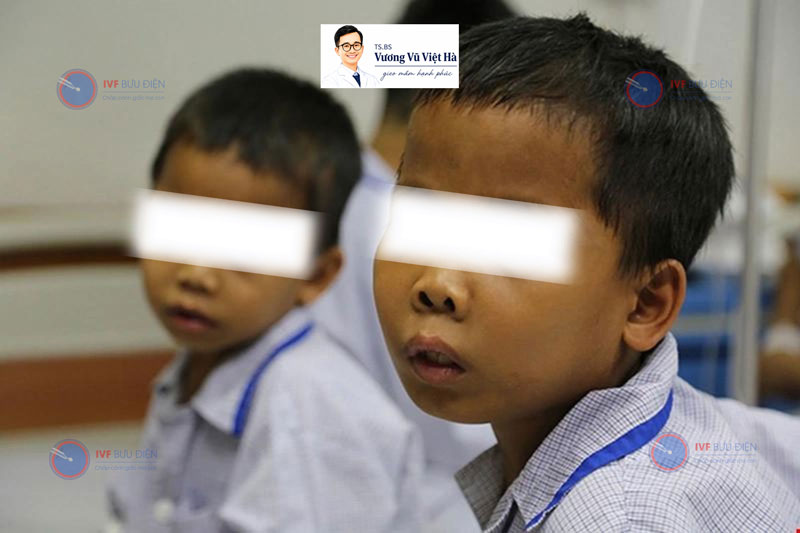 Biểu hiện thường thấy của trẻ bị Thalassemia là hàm hô, mũi tẹt, da sạm màu,…