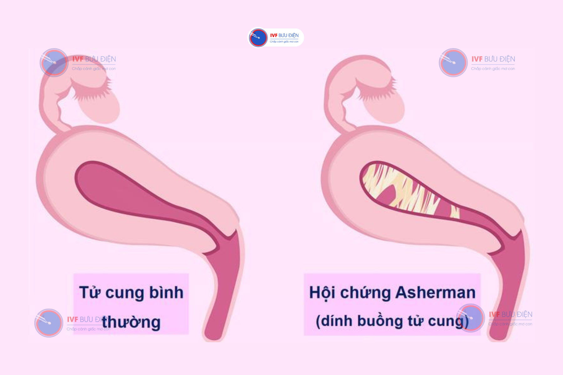 Phẫu thuật nội soi tách dính buồng tử cung