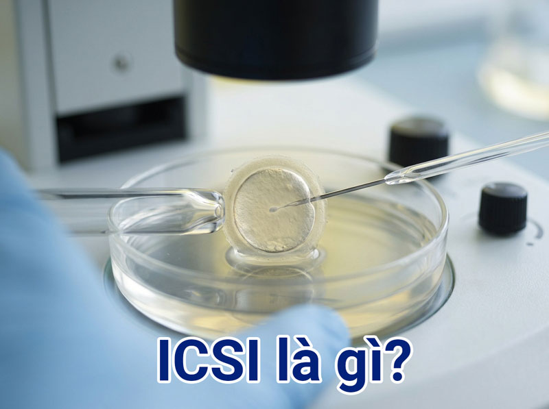 icsi là gì?