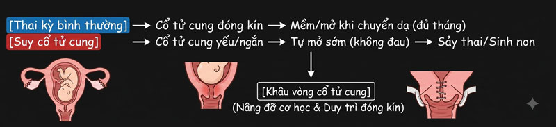 khâu vòng cổ tử cung