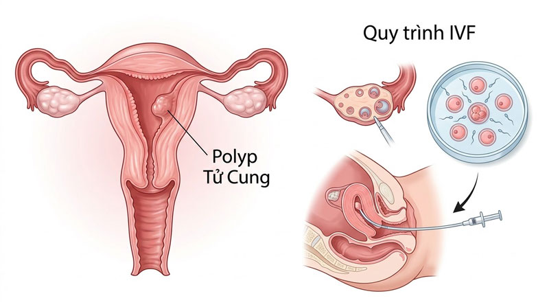 polyp tử cung và ivf