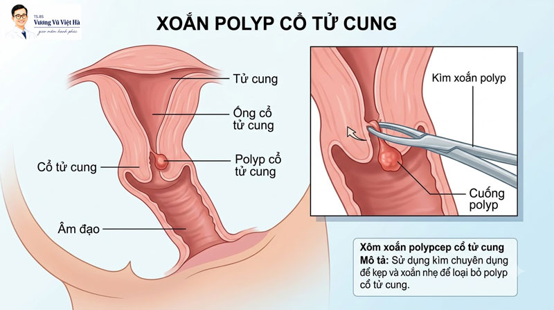 thực hiện xoắn polyp cổ tử cung