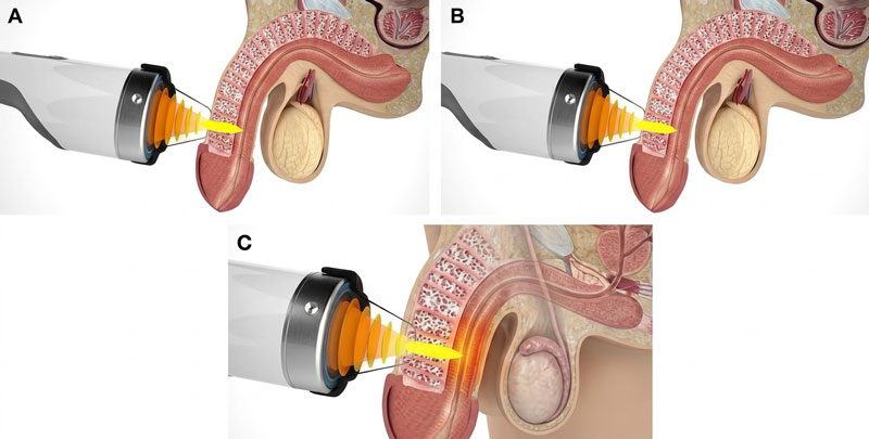 Điều trị rối loạn cương dương bằng sóng xung kích