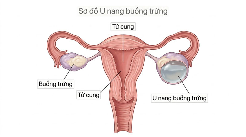 u nang buồng trứng